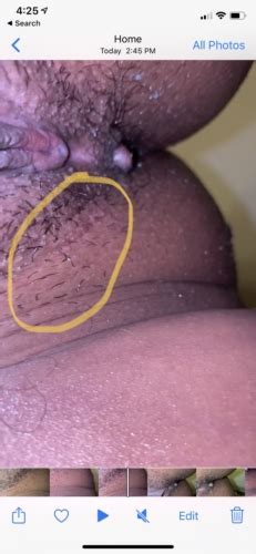 Want To Know If It’s Herpes Outbreak Pls Help Genital Herpes
