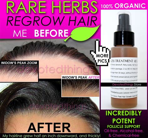Best Organic Hair Regrowth Treatment Hair Loss Thinning Dandruff All In 1