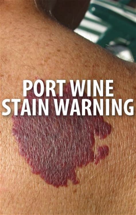 14 best port wine stains images on pinterest wine stains