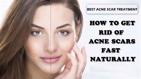 Acne During Menopause