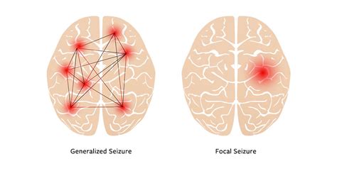 understanding  kinds  seizures nih medlineplus magazine