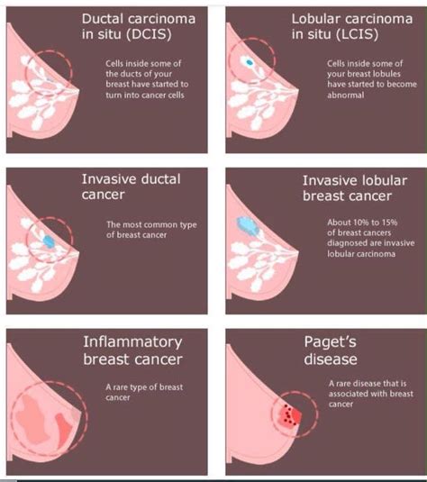 64 best images about inflammatory breast cancer on pinterest do you know what medical center