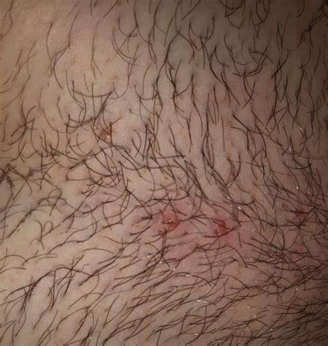 I Can’t Tell If I Have Ingrown Hairs Or Symptoms Of Hpv