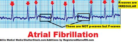 what is the difference between atrial fibrillation a fib and atrial