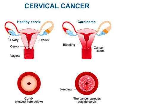 everything you need to know about cervical cancer