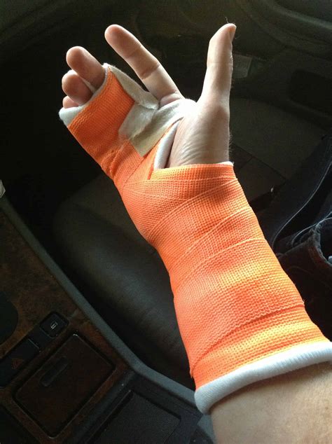 treat  sprained finger physioroom blog