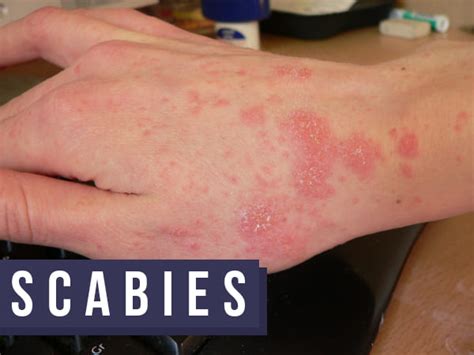 9 home remedies that can help treat scabies safe home diy