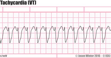 ecg educator blog ventricular tachycardia vt