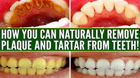 11 effective natural remedies to remove tartar and plaque on teeth