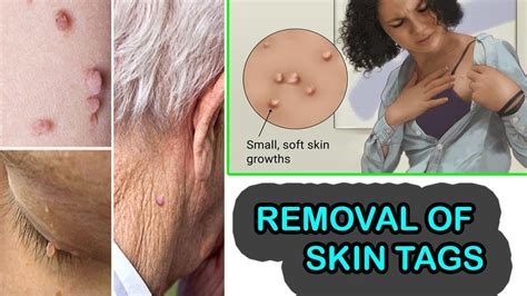 remove skin tags how to remove skin tags at home naturally and