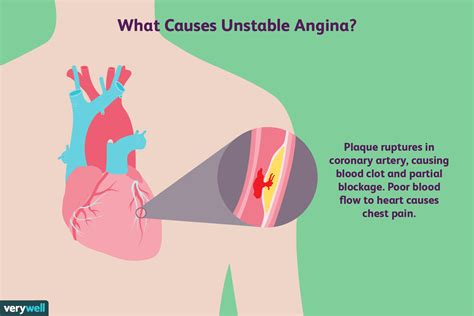 unstable angina symptoms  diagnosis