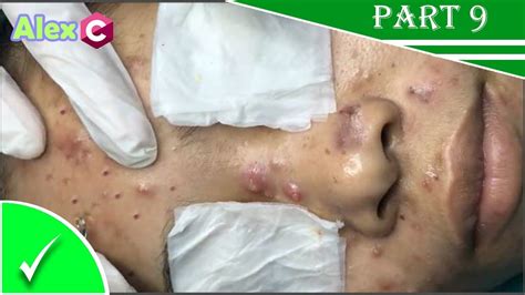 How To Removal Big Pimple Popping Cystic Acne Extraction Skincare Fda
