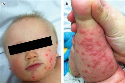 atypical hand foot and mouth disease a vesiculobullous eruption