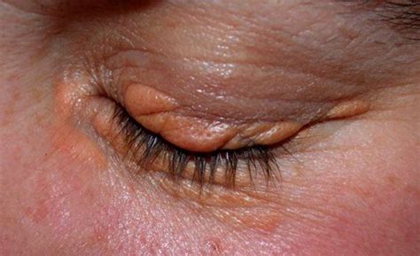 pimple  eyelid    rim small white lump upper eyelid cyst pimple stye treatment