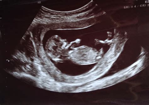 zacksydney  week ultrasound