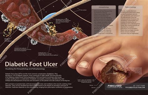 pathophysiology  diabetic foot ulcers wound infection stock photo