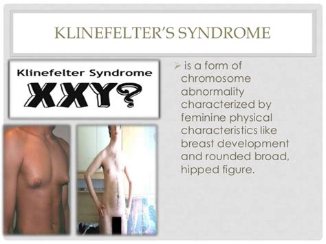 Pervasive Developmental Disorders Turner Syndrome Klinefelters Syn…