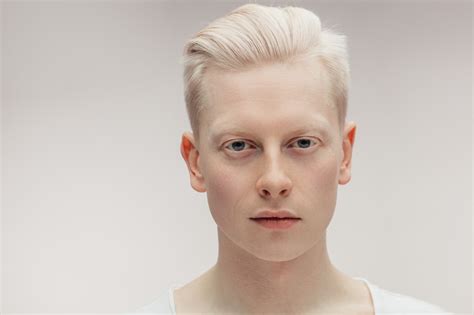 albinos kim jest cechy choroby wykluczenie spoleczne zdrowie wprost