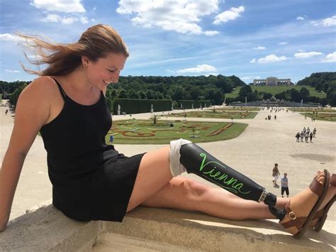 Prosthetic Leg Turns Into Canvas For Chalkboard Art With Special Paint