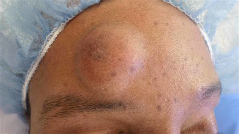 cureus  rare forehead mass  chondroid syringoma