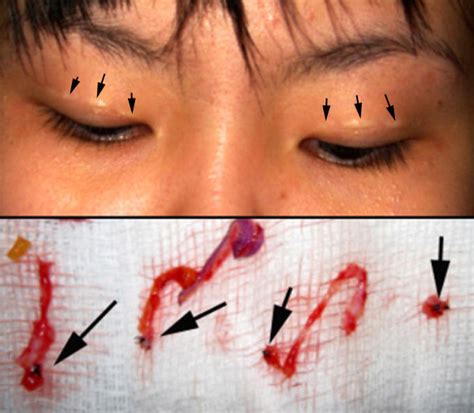 eyelid surgery  prof dr cn chua  double eyelid disaster  beauty salon