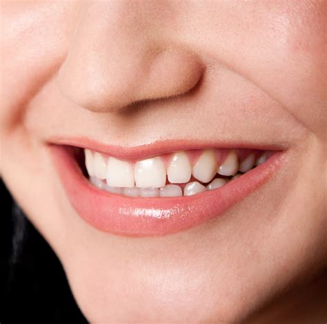the pros and cons of veneers