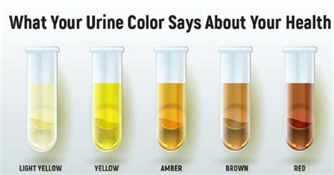 normal urine sodium level neonates malcolm alvarez news