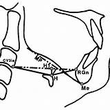 Hyoid Bone Mandibular Variables H1 Airway Morphology Posture Severity sketch template
