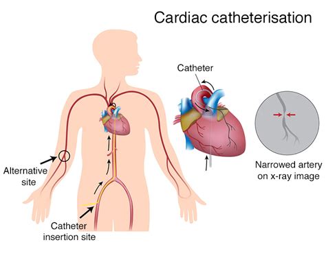 cardiac catheterization shefaa