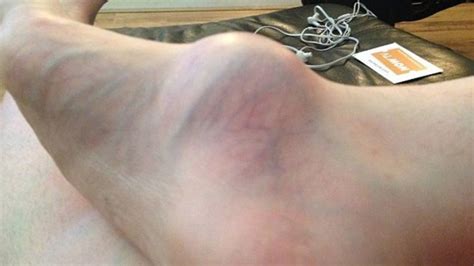 Woman Visits Doctor For Swollen Foot Gets Biggest Shock