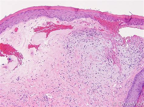 lichen sclerosus of anus