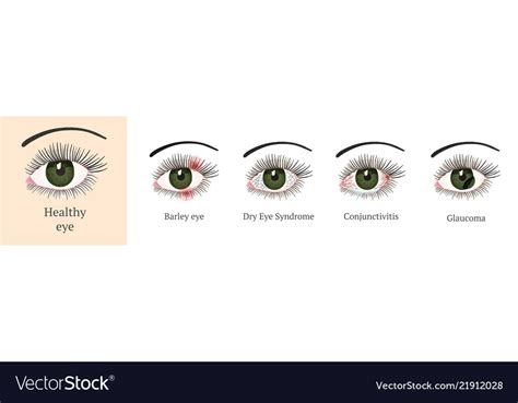 Most Common Eye Problems Royalty Free Vector Image