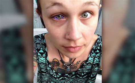 model gets eye tattooed and it goes horribly wrong ny daily news
