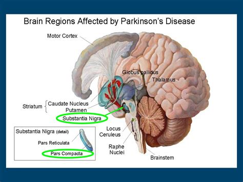 parkinsons disease affect  brain parkinsonsinfoclubcom
