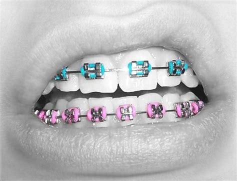 get my braces i dont wanna but i need em with images