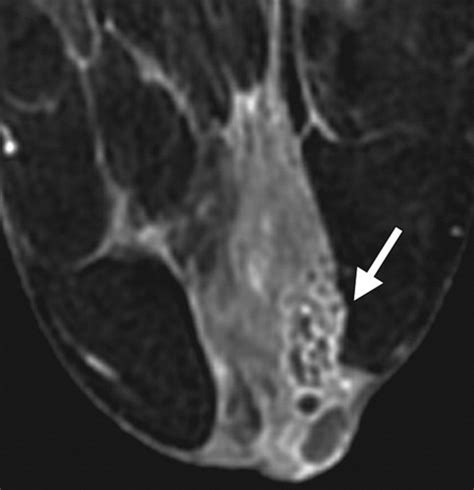 ductal carcinoma in situ of the breast mr imaging findings with