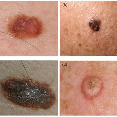 examples  skin lesions  dysplastic nevus  seborrheic
