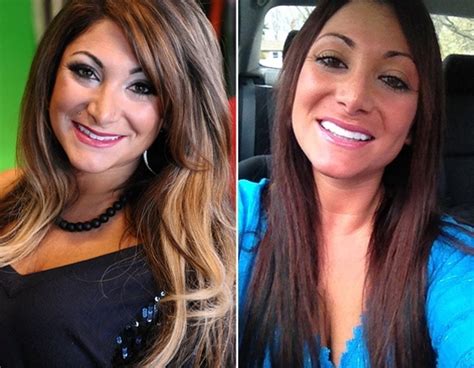 14 Best Images About Veneers On Pinterest Lost Weight