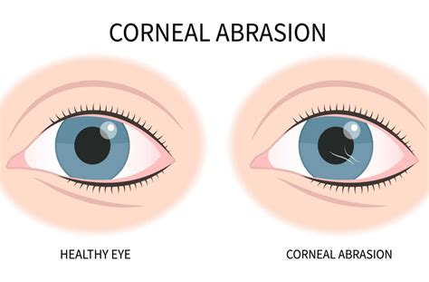 corneal abrasion      treated