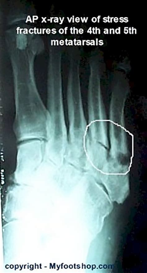 Stress Fractures Of The Foot Causes And Treatment
