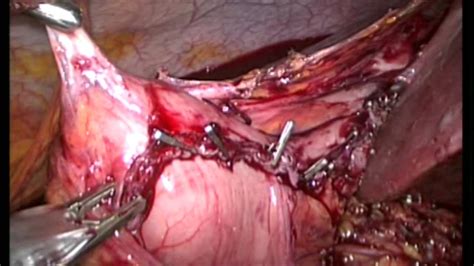 Laparoscopic Lysis Of Adhesions And Redo Of