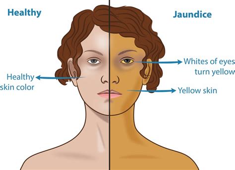yellow skin jaundice pictures symptoms   diagnosis