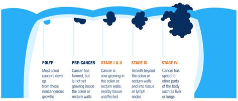 Cancer Of The Colon Stages So How Exactly Does Cancer Of The Colon