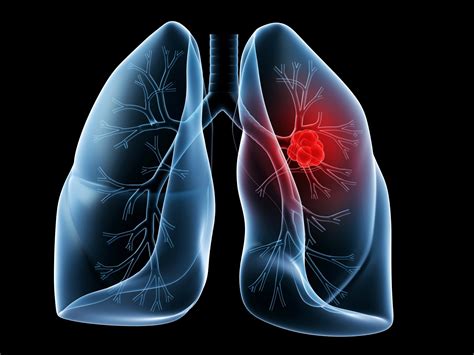 research identifies genetic alterations  lung cancers   select treatment  improve