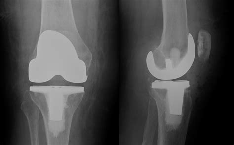Knee Replacement Sussex Knee Surgery