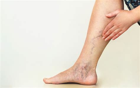 skin damage  vein disease usa vein clinics