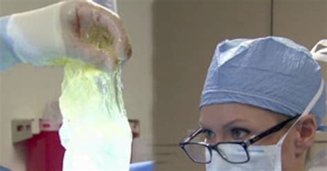 breast cancer survivor s breast implant explodes during surgery—watch