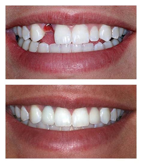 Dental Implants Before And After Bartholomew Dentist
