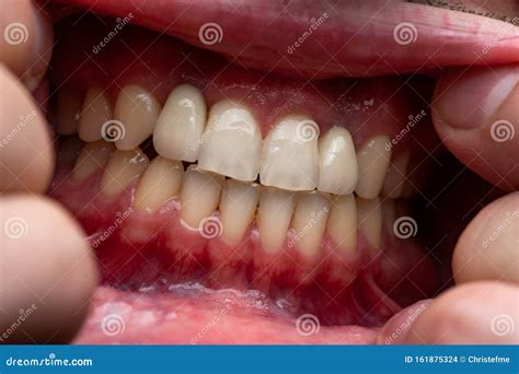 photo  open mouth showing teeth close  stock photo image