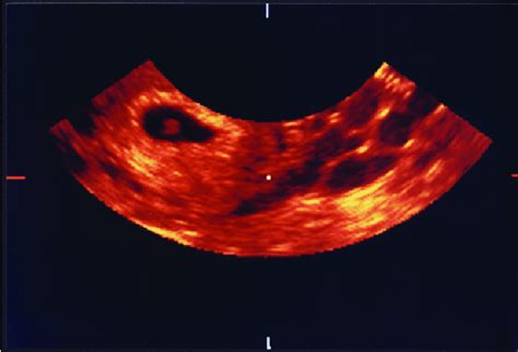 Us Transvaginal Mostrando Saco Gestacional Com Embrião Compatível Com